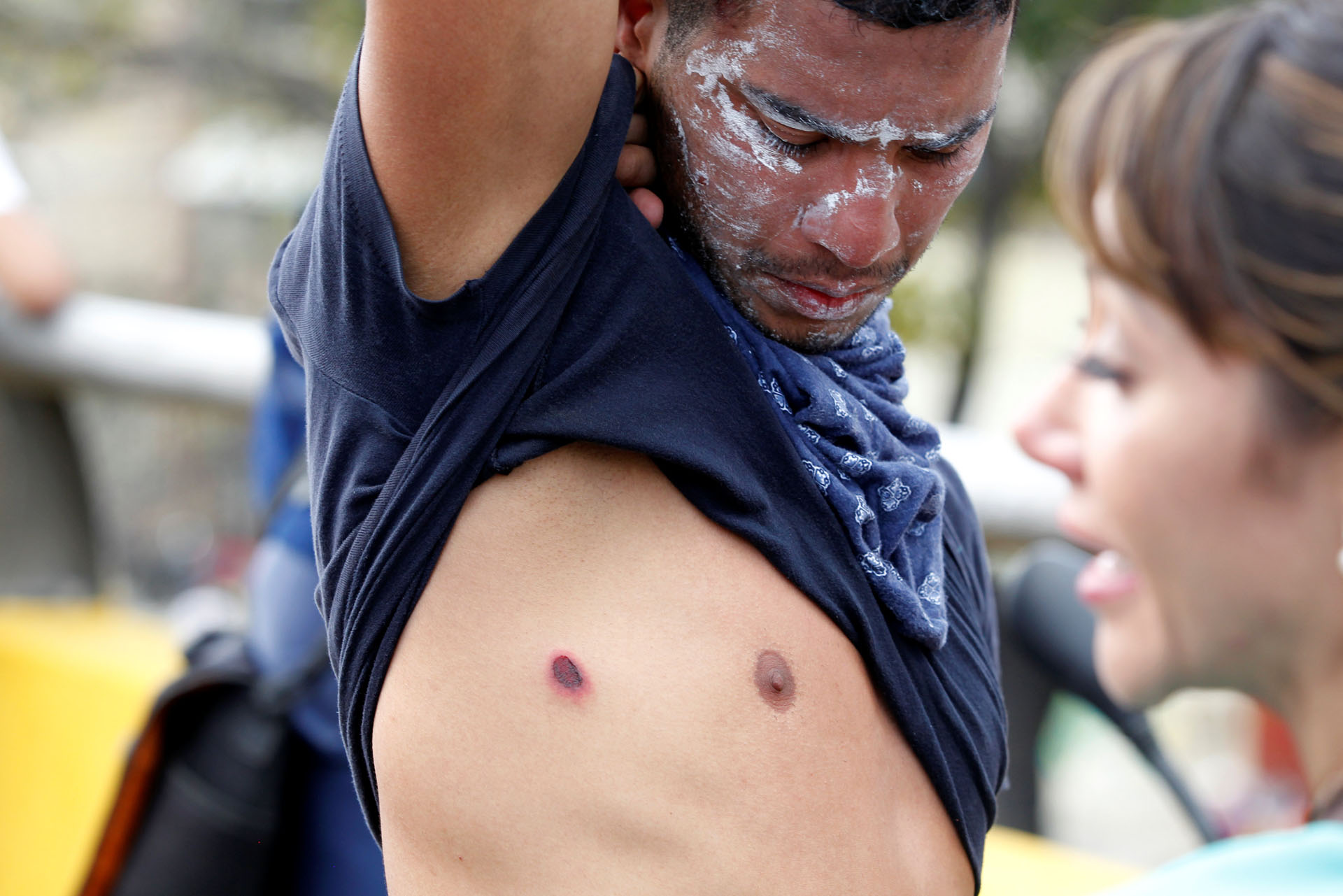 A demonstrator shows an injury caused by rubber bullets fired by the police during an opposition rally in Caracas, Venezuela, April 6, 2017. REUTERS/Christian Veron