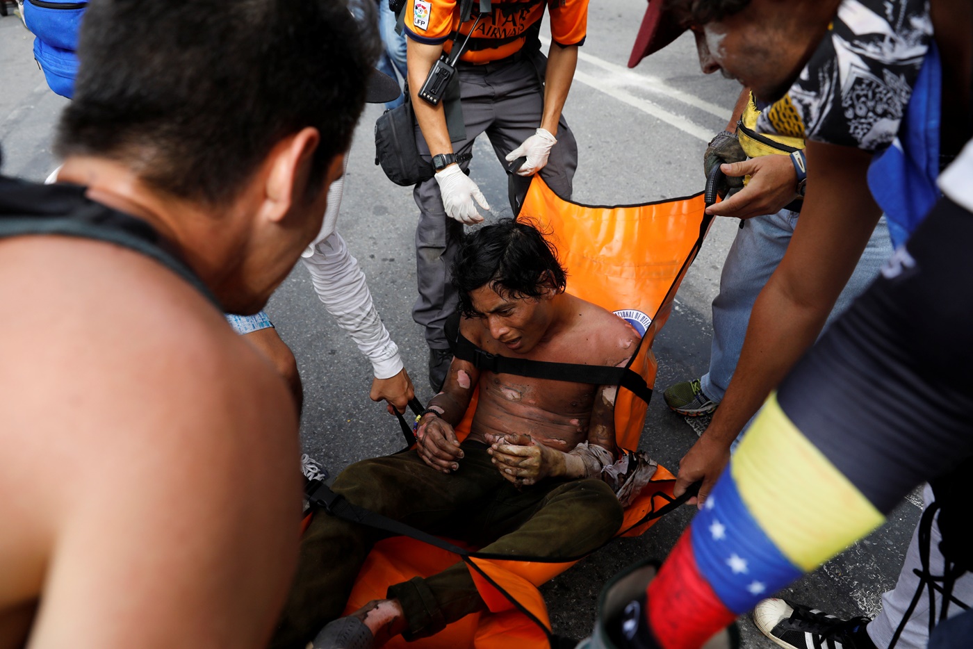 ATTENTION EDITORS - VISUAL COVERAGE OF SCENES OF INJURY OR DEATHAn injured opposition supporter is helped by others during a rally against President Nicolas Maduro in Caracas, Venezuela, May 3, 2017. REUTERS/Carlos Garcia Rawlins TEMPLATE OUT