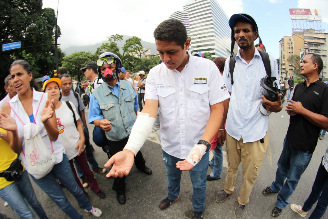 El diputado a la AN, por el estado Vargas, José Manuel Olivares fue uno de los más de 50 heridos tras la represión contra la marcha. Foto: Régulo Gómez / LaPatilla.com