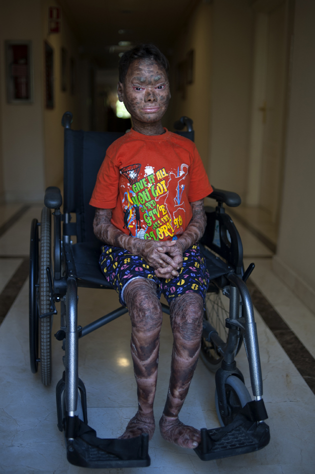 Shalini Yadav, 16, known as the "snake girl" poses in Marbella on September 15, 2017.  Shalini, who suffers recessive lamellar ichthyosis and sheds her skin every six weeks due to a rare condition, is to get life-improving treatment in southern Spain. / AFP PHOTO / JORGE GUERRERO