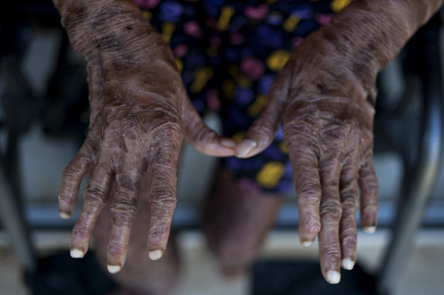 The hands of Shalini Yadav, 16, known as the "snake girl" are pictured in Marbella on September 15, 2017.  Shalini, who suffers recessive lamellar ichthyosis and sheds her skin every six weeks due to a rare condition, is to get life-improving treatment in southern Spain. / AFP PHOTO / JORGE GUERRERO