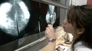 Cáncer de pulmón superará al de mama como causa de muerte entre mujeres