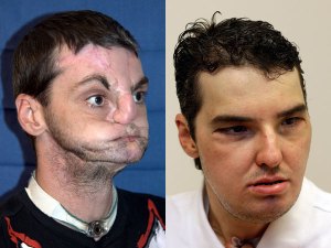 Impresionante trasplante de rostro (Fotos)