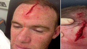 Rooney muestra su “frente cortada” para acallar a la crítica