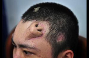 Médicos chinos satisfechos de nariz que crece en la frente de un paciente