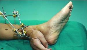 Le implantan una mano en el pie para mantenerla con vida (Foto)
