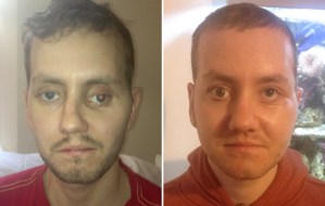 La cara destrozada de un hombre reconstruida con impresora 3D (Fotos)