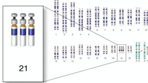 Nuevo descubrimiento sobre el síndrome de Down