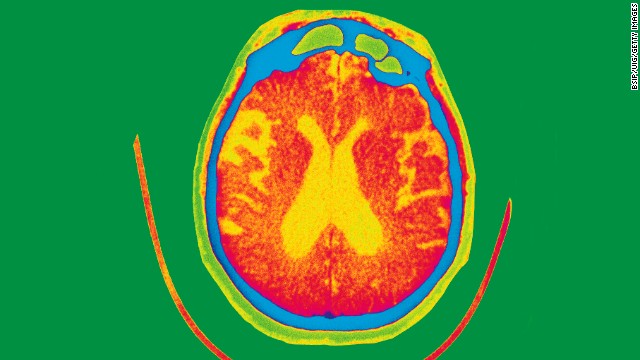 Cinco cosas que no sabías del Alzheimer