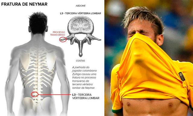 Conoce cómo es la fractura de Neymar (Infografía)