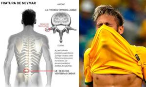 Conoce cómo es la fractura de Neymar (Infografía)