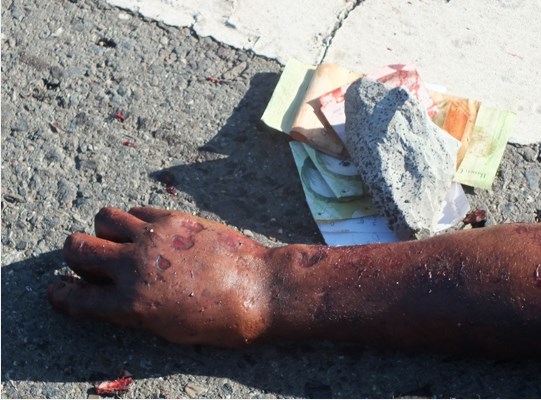 Un obrero quedó irreconocible al ser arrollado en la carretera Lara-Zulia