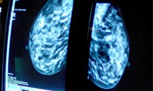 Tratamiento de Roche para el cáncer de mamas muestra beneficios “sin precedentes”