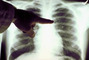 Los pacientes con cáncer de pulmón pueden vivir más con inmunoterapia
