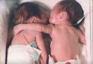 Una recién nacida estaba muriendo, la acostaron junto a su hermana gemela y luego ocurrió un milagro