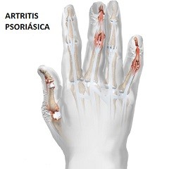 artritis psoriasica