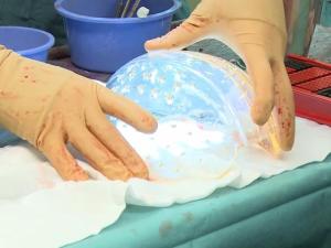 Trasplantan un cráneo impreso en 3D a una niña con hidrocefalia