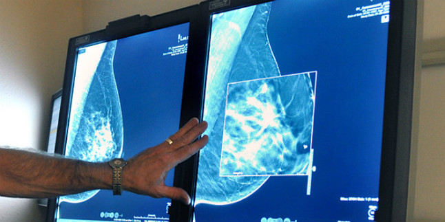 Logran incrementar la eficacia de la inmunoterapia en el cáncer de mama