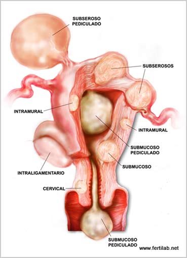 Factor uterino-9