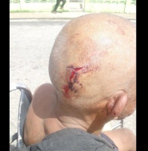 Gloriosa GNB hirió en la cabeza a hombre en silla de ruedas que protestaba por comida en Tucupita (FOTOS)