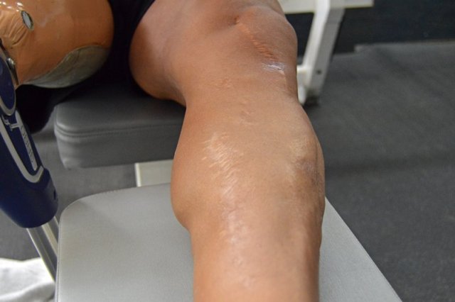 Esta es la pierna “sana” donde tiene unos 80 clavos y tornillos. Una larga cicatriz le adorna. Foto: William Ceballos.