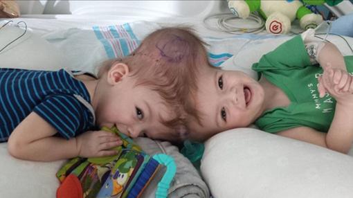 Los gemelos Jadon y Anias McDonald nacieron unidos por la cabeza- FACEBOOK