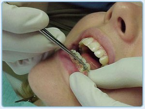 Altos precios de insumos ponen en riesgo el servicio de ortodoncia
