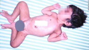 Operan con éxito a un niño indio nacido con cuatro piernas y dos penes (foto fuerte)