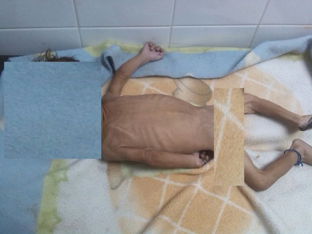 Niño muerto por desnutrición en Aragua