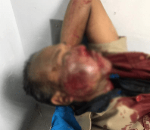 Foto: @joseolivaresm / Herido por bombazo en la cara este #31May