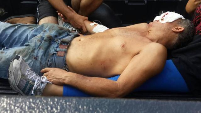 Uno de los heridos en el ojo izquierdo identificado como Cesar Augusto Villamarin Contreras 42 años es trasladado a #Mérida. Foto: @Leoperiodista