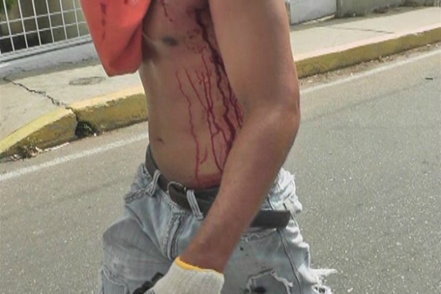 Foto:  Manifestante resultó herido en el Zulia por represión de la GNB  / Cortesía 