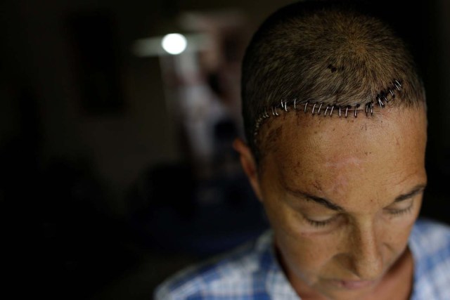 Yolyter Rodriguez, de 56, madre de tres hijos, posa en su casa de Caracas con una herida en la cabeza provocada por el impacto de un cartucho metálico de gas lacrimógeno en su cabeza. UESLEI MARCELINO REUTERS