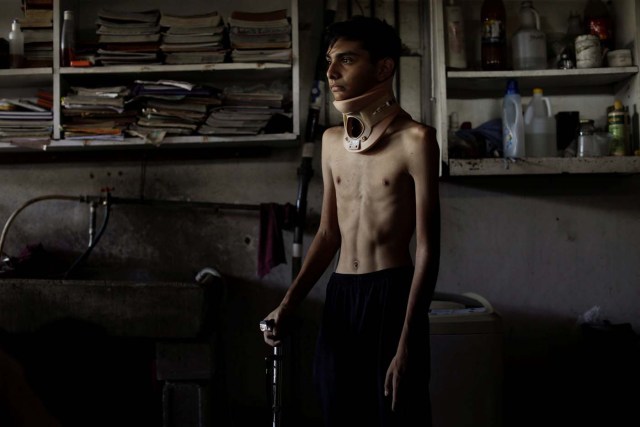 Jofre Rodriguez, 18, who was injured during a protest against Venezuela's President Nicolas Maduro's government, poses for a photograph at his home in Turmero, Venezuela, August 11, 2017. Rodriguez said his jaw was fractured by a gunshot on June 26, 2017. He underwent surgery to remove a projectile that was lodged in a vertebra but he still needs treatment and jaw reconstruction surgery. "This constituent assembly is a perversion meant to consolidate them (the ruling party) in power. I'm protesting against that. It saddens me to see my country like this. With Chavez, we had a dictatorship with a 'political leader,' with Maduro we have a political disaster," he said. "I'm only 18 years old, but I'm living through the decline of Venezuela. Was it worth it? Yes, like those who died, what happened to me was a sacrifice that has inspired many people in the struggle." REUTERS/Ueslei Marcelino SEARCH "VENEZUELA INJURIES" FOR THIS STORY. SEARCH "WIDER IMAGE" FOR ALL STORIES.