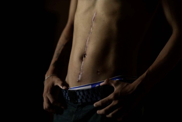 Manuel Melo, 21, a student, who was injured during a protest against Venezuela's President Nicolas Maduro's government, poses for a photograph inside his home in Caracas, Venezuela, August 3, 2017. Melo said he was hit by a police water cannon on May 22, 2017. He sustained internal injuries and lost a kidney. "I'm protesting because simple things cost a lot of money, the minimum wage is not good, the country is not good. I protest against insecurity, lack of medicine. I have millions of reasons. A man with less education than me cannot govern, we need someone new, from a university, with true principles and values." REUTERS/Ueslei Marcelino SEARCH "VENEZUELA INJURIES" FOR THIS STORY. SEARCH "WIDER IMAGE" FOR ALL STORIES.