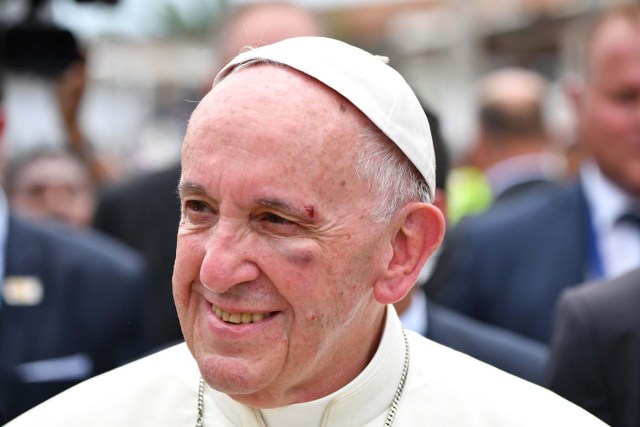 Pope Francis shows a bruise around his left eye and eyebrow caused by an accidental hit against the popemobile's window glass while visiting the old sector of Cartagena, Colombia, on September 10, 2017. Nearly 1.3 million worshippers flocked to a mass by Pope Francis on Saturday in the Colombian city known as the stronghold of the late drug lord Pablo Escobar. / AFP PHOTO / Alberto PIZZOLI