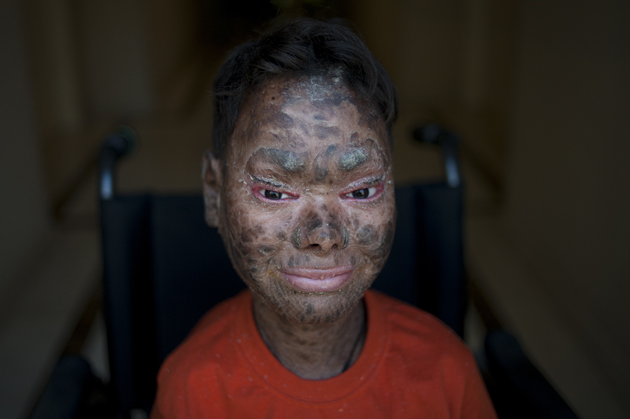 Shalini Yadav, 16, known as the "snake girl" poses in Marbella on September 15, 2017.  Shalini, who suffers recessive lamellar ichthyosis and sheds her skin every six weeks due to a rare condition, is to get life-improving treatment in southern Spain. / AFP PHOTO / JORGE GUERRERO