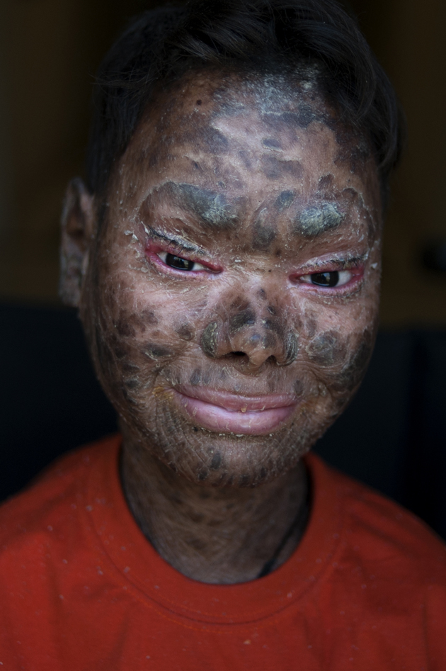 Shalini Yadav, 16, known as the "snake girl" poses in Marbella on September 15, 2017.  Shalini, who suffers recessive lamellar ichthyosis and sheds her skin every six weeks due to a rare condition, is to get life-improving treatment in southern Spain. / AFP PHOTO / JORGE GUERRERO