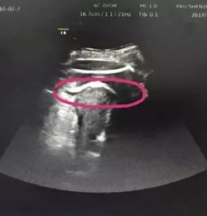 Foto: Una mujer embarazada ha estado a punto de morir porque su bebé perforó el útero de una patada / Gizmodo 
