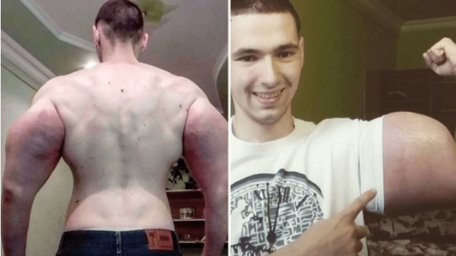 Kirill Tereshin, el joven que se inyecta aceite en los brazos