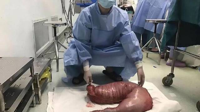 doctors-at-shanghai-tenth-peoples-hospital-removed-nearly-30-pounds-of-feces