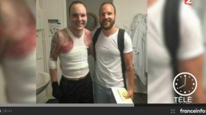 Un quemado casi integral sobrevive gracias al trasplante de la piel de su gemelo