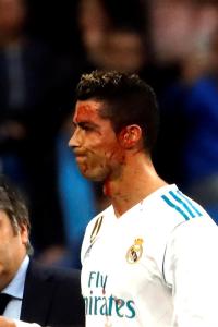 Cristiano Ronaldo recibió una patada en la cabeza que le dejó herida para puntos (Fotos)