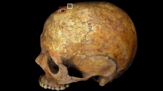 Los restos medievales hallados en Imola, Italia. Foto: World Neurosurgery