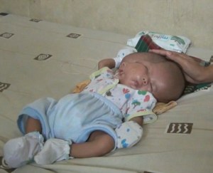 ¡HORROR!… nace un bebé con dos caras y una cabeza en Indonesia (VIDEO)