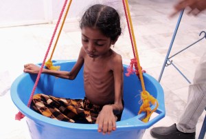 La vida de los niños en el Yemen se agota por la malnutrición (Fotos)