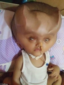 La hidranencefalia dejó a un pobre bebé con “cuernos de demonio” (FOTOS)