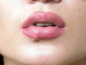El beso romántico importado de países orientales pudo extender el herpes labial en Europa, reveló estudio