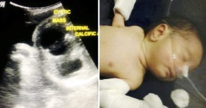 La increíble historia de la bebé que nació embarazada de su hermano