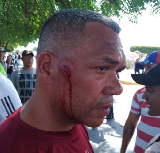Manifestante en Zulia herido de perdigón en la cara. Foto @angelespinatv